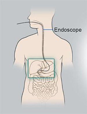 upper gastrointestinal disease endoscopy sydney
