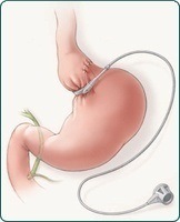 Laparoscopic Gastric Banding in Sydney