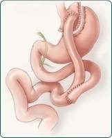 Laparoscopic Gastric Bypass in Sydney