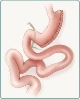 Laparoscopic Sleeve Gastrectomy in Sydney