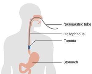 oesophageal cancer sydney