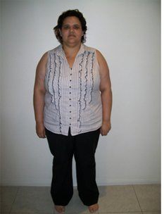 Rebecca 12months Before Sleeve Gastrectomy1