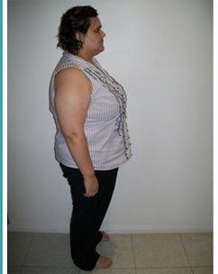 Rebecca 12months Before Sleeve Gastrectomy2